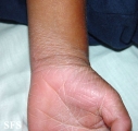 erythrokeratodermia progressive symmetric