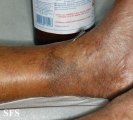 leprosy tuberculoid