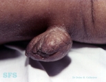 acrochordon