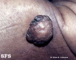 acrochordon