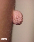 acrochordon