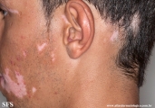 alopecia_areata_and_vitiligo
