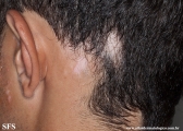 alopecia_areata_and_vitiligo