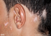 alopecia_areata_and_vitiligo