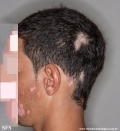 alopecia_areata_and_vitiligo