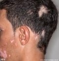 alopecia_areata_and_vitiligo