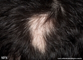 alopecia_areata_and_vitiligo
