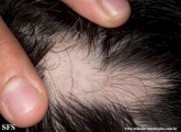alopecia_areata_and_vitiligo