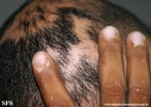 alopecia_areata_and_vitiligo
