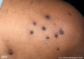 reative perforating collagenosis