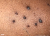 reative perforating collagenosis