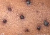 reative perforating collagenosis