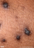 reative perforating collagenosis