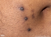 reative perforating collagenosis
