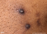 reative perforating collagenosis