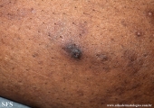 reative perforating collagenosis