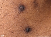 reative perforating collagenosis
