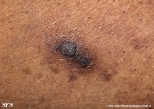 reative perforating collagenosis