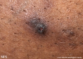 reative perforating collagenosis