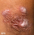 reative perforating collagenosis