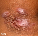 reative perforating collagenosis