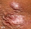 reative perforating collagenosis