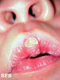 callosities of the lips