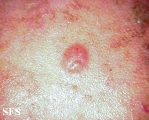 sebaceous carcinoma