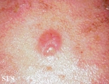 sebaceous carcinoma