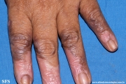 lichen_ruber_planus_with paradoxial-evolution_to_vitiligo