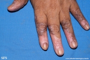 lichen_ruber_planus_with paradoxial-evolution_to_vitiligo