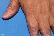 lichen_ruber_planus_with paradoxial-evolution_to_vitiligo