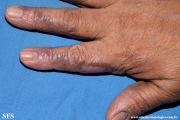 lichen_ruber_planus_with paradoxial-evolution_to_vitiligo