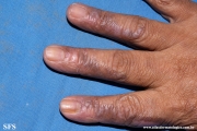 lichen_ruber_planus_with paradoxial-evolution_to_vitiligo