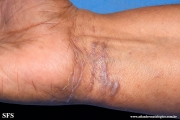 lichen_ruber_planus_with paradoxial-evolution_to_vitiligo