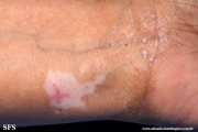 lichen_ruber_planus_with paradoxial-evolution_to_vitiligo