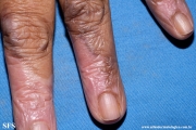 lichen_ruber_planus_with paradoxial-evolution_to_vitiligo