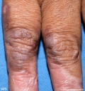 lichen_ruber_planus_with paradoxial-evolution_to_vitiligo