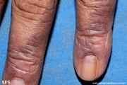 lichen_ruber_planus_with paradoxial-evolution_to_vitiligo