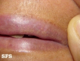 fordyce spots