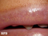 fordyce spots
