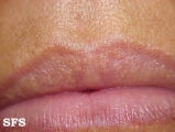 fordyce spots