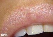 fordyce spots