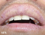 fordyce spots