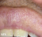 fordyce spots