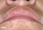 fordyce spots