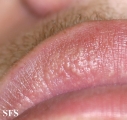fordyce spots
