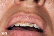 fordyce spots