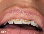 fordyce spots