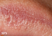 fordyce spots
